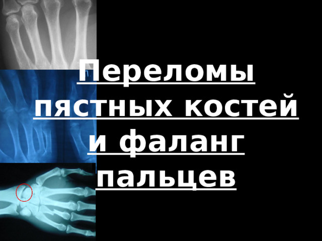 Чем опасен перелом голеностопного сустава. Перелом голеностопного сустава: признаки, первая помощь и особенности. Перелом голеностопного сустава: симптомы и лечение Боль в голеностопе: почему болит голеностопный сустав и что в этом.