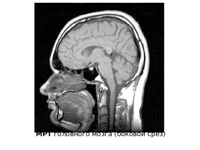 МРТ головного мозга (боковой срез) 