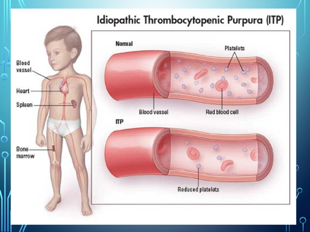 Пурпура симптомы фото Тромбоцитопениялық пурпура - Биология - Презентации - ВУЗ