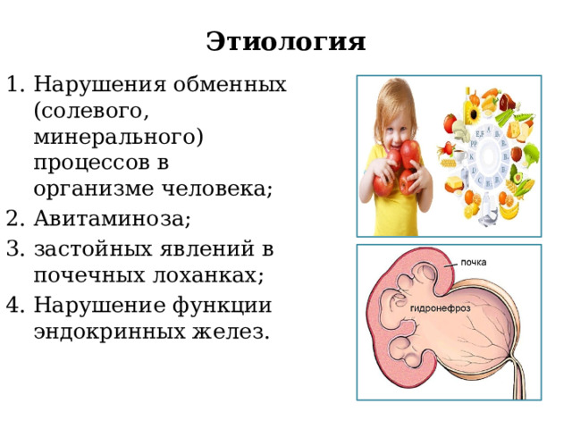Этиология Нарушения обменных (солевого, минерального) процессов в организме человека; Авитаминоза; застойных явлений в почечных лоханках; Нарушение функции эндокринных желез. 