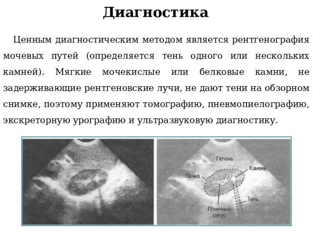 Диагностика Ценным диагностическим методом является рентгенография мочевых путей (определяется тень одного или нескольких камней). Мягкие мочекислые или белковые камни, не задерживающие рентгеновские лучи, не дают тени на обзорном снимке, поэтому применяют томографию, пневмопиелографию, экскреторную урографию и ультразвуковую диагностику. 