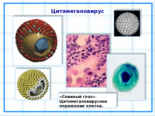 Цитамегаловирус «Совиный глаз». Цитомегаловирусное поражение клетки. 