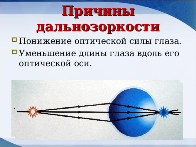 Причины дальнозоркости Понижение оптической силы глаза. Уменьшение длины глаза вдоль его оптической оси. 