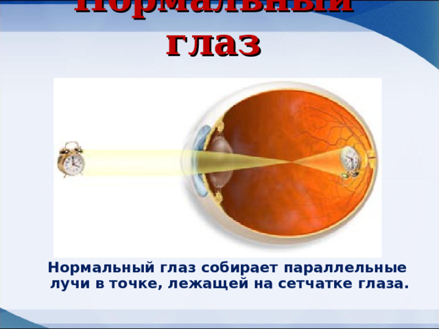 Нормальный глаз  Нормальный глаз собирает параллельные лучи в точке, лежащей на сетчатке глаза. 