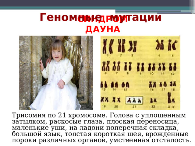 Геномные мутации Синдром Дауна Трисомия по 21 хромосоме. Голова с уплощенным затылком, раскосые глаза, плоская переносица, маленькие уши, на ладони поперечная складка, большой язык, толстая короткая шея, врожденные пороки различных органов, умственная отсталость. 