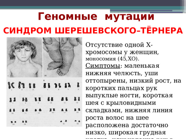 Геномные мутации Синдром Шерешевского–Тёрнера Отсутствие одной Х-хромосомы у женщин, моносомия (45,ХО). Симптомы : маленькая нижняя челюсть, уши оттопырены, низкий рост, на коротких пальцах рук выпуклые ногти, короткая шея с крыловидными складками, нижняя линия роста волос на шее расположена достаточно низко, широкая грудная клетка, искривление рук в области локтей.   