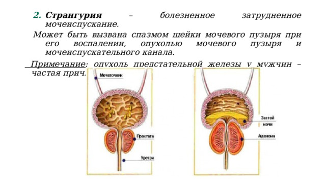 Странгурия – болезненное затрудненное мочеиспускание. Странгурия – болезненное затрудненное мочеиспускание. Может быть вызвана спазмом шейки мочевого пузыря при его воспалении, опухолью мочевого пузыря и мочеиспускательного канала.  Примечание: опухоль предстательной железы у мужчин – частая причина странгурии. 