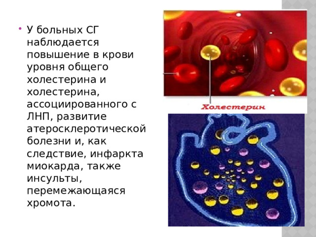У больных СГ наблюдается повышение в крови уровня общего холестерина и холестерина, ассоциированного с ЛНП, развитие атеросклеротической болезни и, как следствие, инфаркта миокарда, также инсульты, перемежающаяся хромота. 