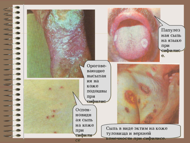 Папулезная сыпь на языке при сифилисе. Орогове-вающие высыпания на коже подошвы при сифилисе. Оспен-новидная сыпь на коже при сифилисе Сыпь в виде эктим на коже туловища и верхней конечности при сифилисе. 