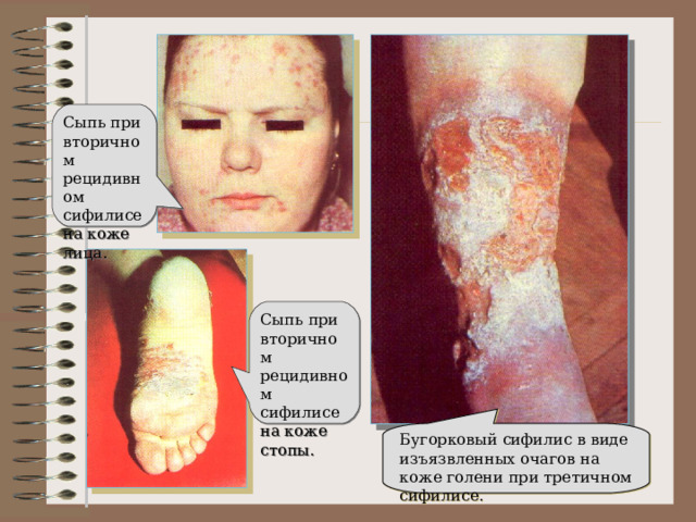Сыпь при вторичном рецидивном сифилисе на коже лица. Сыпь при вторичном рецидивном сифилисе на коже стопы. Бугорковый сифилис в виде изъязвленных очагов на коже голени при третичном сифилисе. 