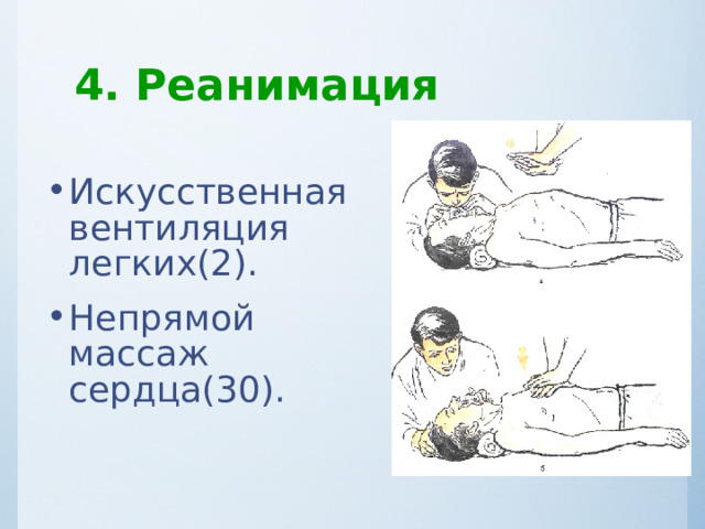 4. Реанимация Искусственная вентиляция легких(2). Непрямой массаж сердца(30). 