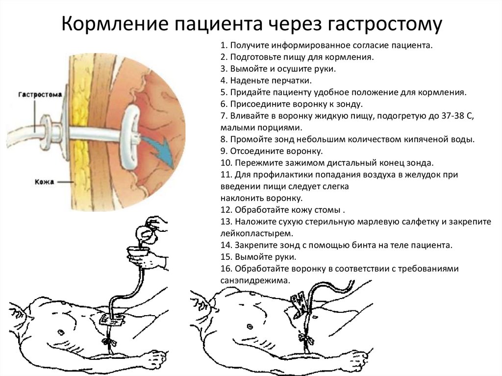 Кормление пациента через рот алгоритм. Кормление тяжелобольных пациентов презентация. Кормление пациента через гастростому. Кормление пациента через гастростому по неделям. Кормление больных при отказе от еды алгоритм.