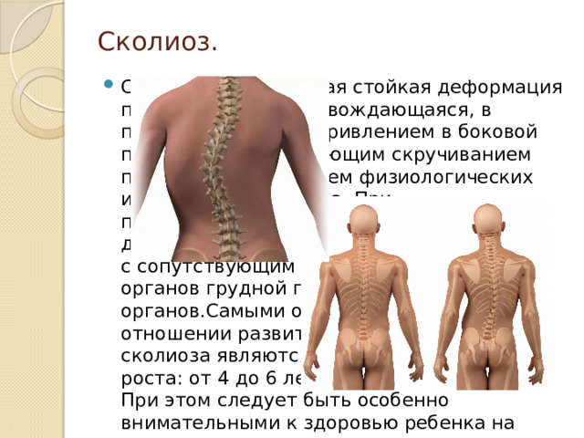 Стул при искривлении позвоночника