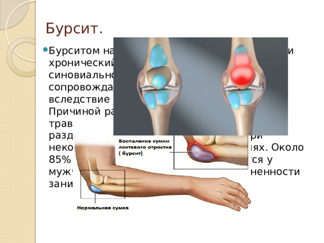 Компресс при бурсите коленного сустава. Бурсит коленного сустава - симптомы и лечение Компрессы при артрозе коленного сустава Лечение бурсита коленного сустава в домашних условиях: народные.