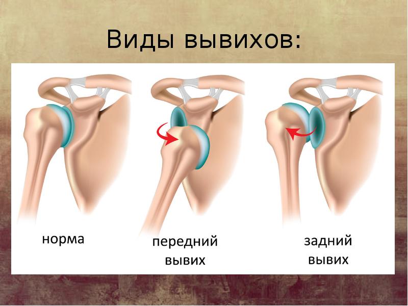 Что такое вывих. Вывихи суставов классификация.