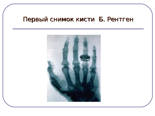 Первый снимок кисти Б. Рентген 