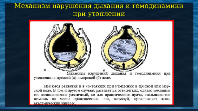 Механизм нарушения дыхания и гемодинамики при утоплении 