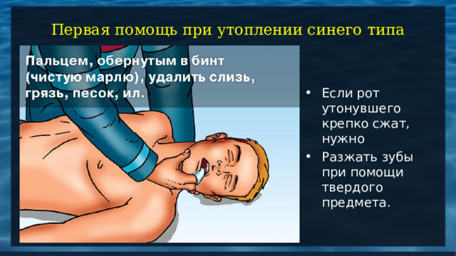 Первая помощь при утоплении синего типа Если рот утонувшего крепко сжат, нужно Разжать зубы при помощи твердого предмета. 