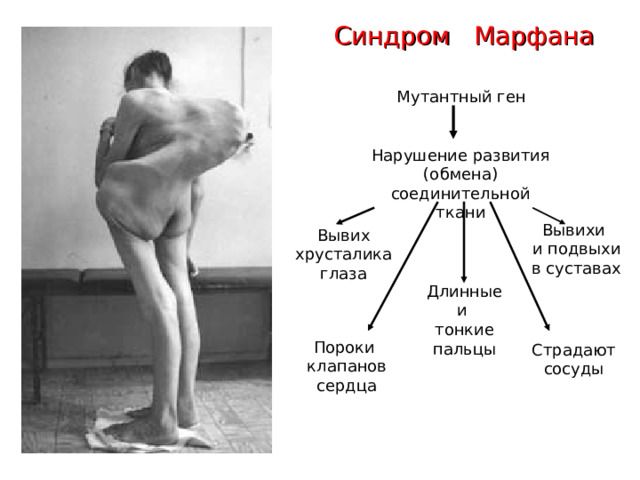 Синдром Марфана Мутантный ген Нарушение развития (обмена) соединительной ткани Вывихи и подвыхи в суставах Вывих хрусталика глаза Длинные и тонкие пальцы Пороки клапанов сердца Страдают сосуды 