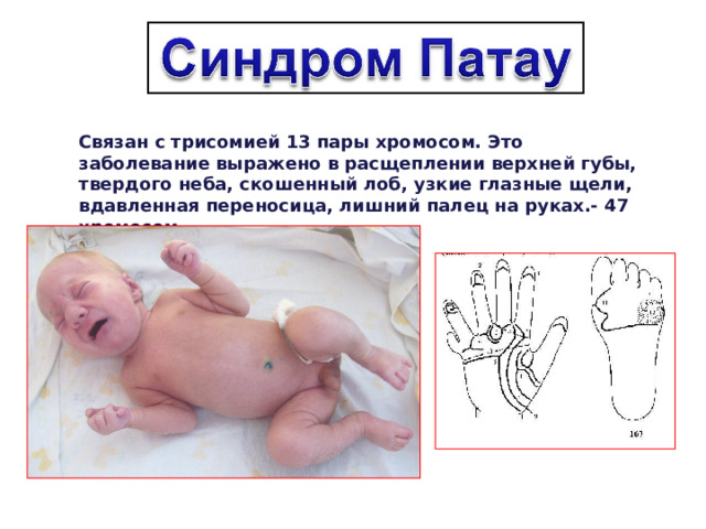 Связан с трисомией 13 пары хромосом. Это заболевание выражено в расщеплении верхней губы, твердого неба, скошенный лоб, узкие глазные щели, вдавленная переносица, лишний палец на руках.- 47 хромосом 