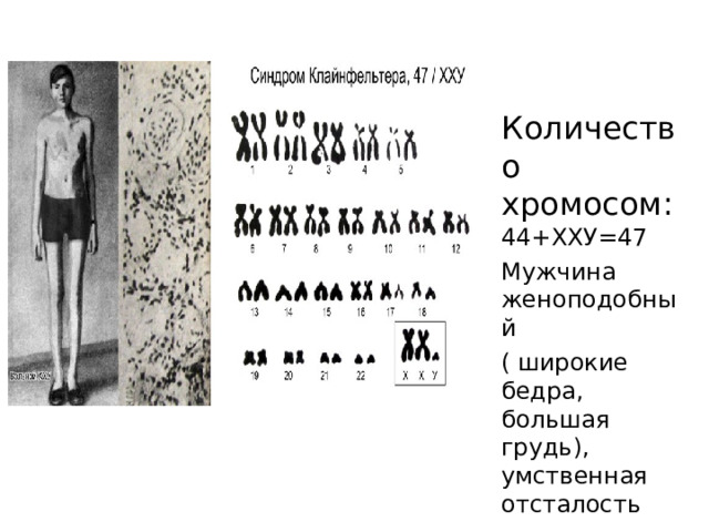 Количество хромосом: 44+ХХУ=47 Мужчина женоподобный ( широкие бедра, большая грудь), умственная отсталость 