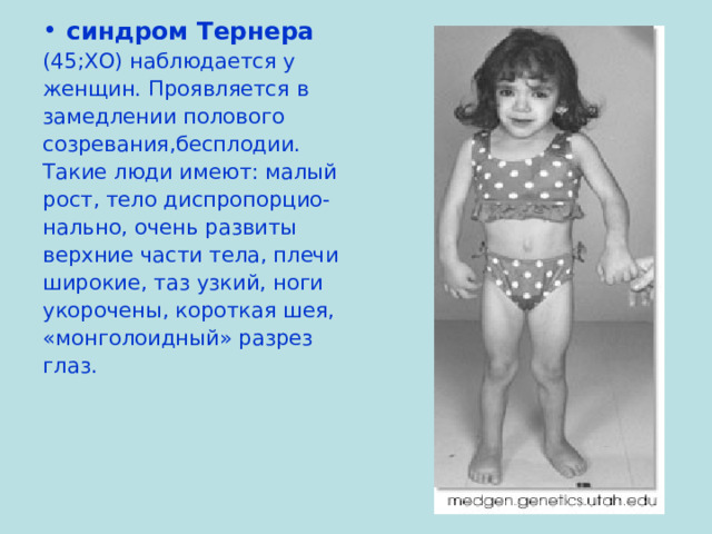 синдром Тернера (45;ХО) наблюдается у женщин. Проявляется в замедлении полового созревания,бесплодии. Такие люди имеют: малый рост, тело диспропорцио- нально, очень развиты верхние части тела, плечи широкие, таз узкий, ноги укорочены, короткая шея, «монголоидный» разрез глаз. 