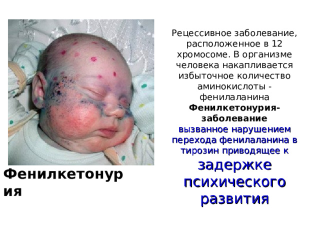 Рецессивное заболевание, расположенное в 12 хромосоме. В организме человека накапливается избыточное количество аминокислоты - фенилаланина  Фенилкетонурия-заболевание  вызванное нарушением перехода фенилаланина в тирозин приводящее к задержке психического развития Фенилкетонурия 