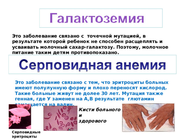 Это заболевание связано с точечной мутацией, в результате которой ребенок не способен расщеплять и усваивать молочный сахар-галактозу. Поэтому, молочное питание таким детям противопоказано. Это заболевание связано с тем, что эритроциты больных имеют полулунную форму и плохо переносят кислород. Такие больные живут не долее 30 лет. Мутация также генная, где У заменен на А,В результате глютамин замещается на валин. Кисти больного и здорового Серповидные эритроциты 
