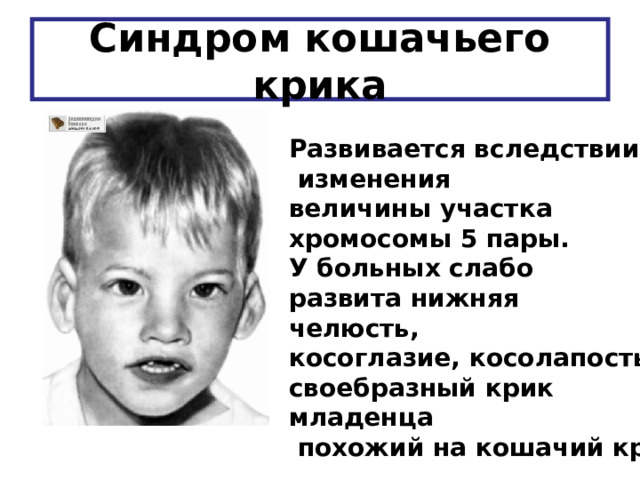 Синдром кошачьего крика Развивается вследствии  изменения величины участка хромосомы 5 пары. У больных слабо развита нижняя челюсть, косоглазие, косолапость, своебразный крик младенца  похожий на кошачий крик 