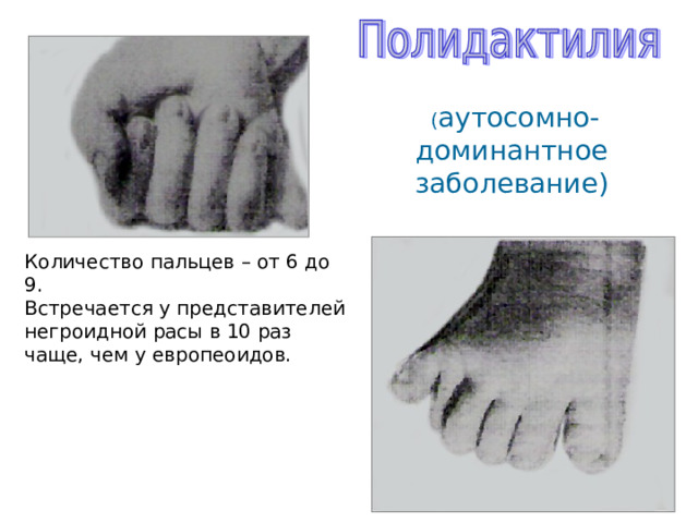  ( аутосомно-доминантное заболевание) Количество пальцев – от 6 до 9. Встречается у представителей негроидной расы в 10 раз чаще, чем у европеоидов. 