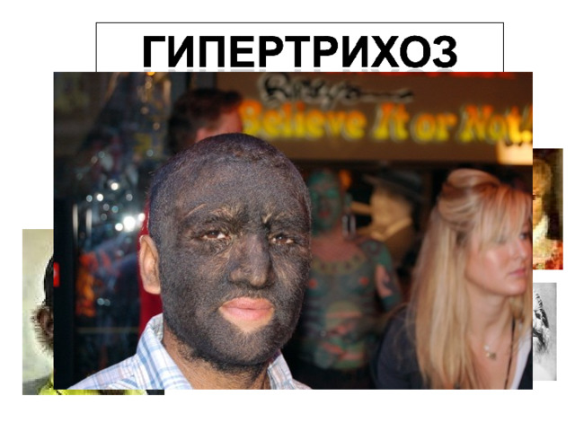 Гипертрихоз-это избыточное оволосение у мужчин. Избыточное оволосение женщин по мужскому типу называется гирсутизм. Причинами гипертрихоза являются: 1.Повышенный уровень половых гормонов 2.Генетические причины 3.Лекарственные причины(избыток кортикостероидов) 4.Идиопатический тип. 
