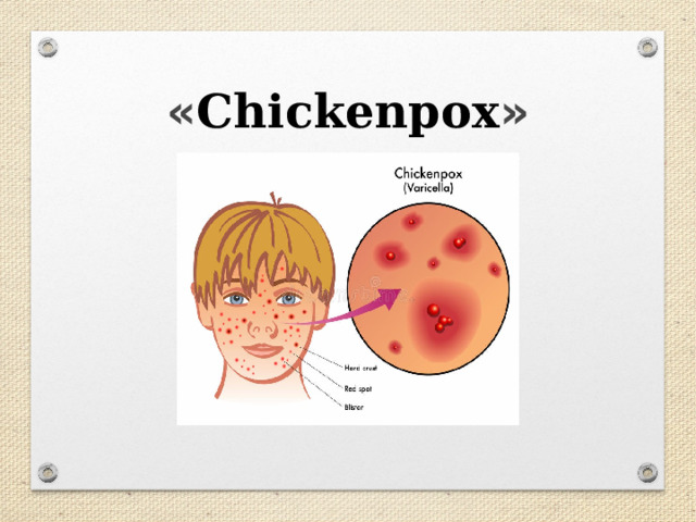 « Chickenpox » 