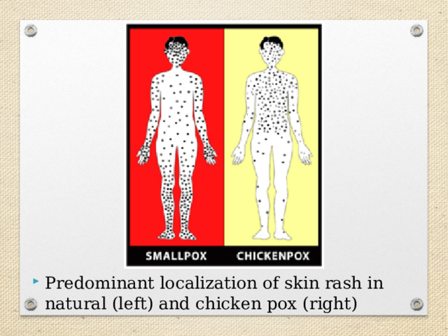 Predominant localization of skin rash in natural (left) and chicken pox (right) 