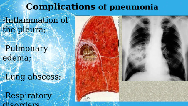 Complications of pneumonia -Inflammation of the pleura; -Pulmonary edema; -Lung abscess; -Respiratory disorders. 