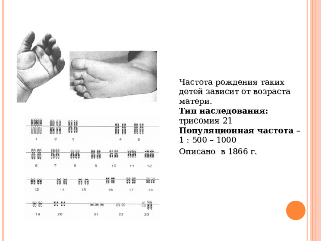 Частота рождения таких детей зависит от возраста матери. Тип наследования: трисомия 21 Популяционная частота – 1 : 500 – 1000 Описано в 1866 г. 