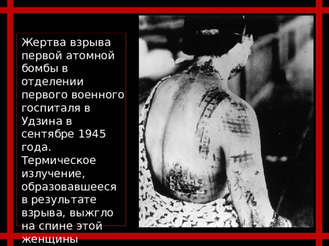 Жертва взрыва первой атомной бомбы в отделении первого военного госпиталя в Удзина в сентябре 1945 года. Термическое излучение, образовавшееся в результате взрыва, выжгло на спине этой женщины рисунок с ткани кимоно. 