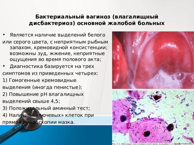 Бактериальный вагиноз (влагалищный дисбактериоз) основной жалобой больных Является наличие выделений белого или серого цвета, с неприятным рыбным запахом, кремовидной консистенции; возможны зуд, жжение, неприятные ощущения во время полового акта; Диагностика базируется на трех симптомов из приведенных четырех: 1) Гомогенные кремовидные выделения (иногда пенистые); 2) Повышение pH влагалищных выделений свыше 4,5; 3) Положительный аминный тест; 4) Наличие «ключевых» клеток при прямой микроскопии мазка. 