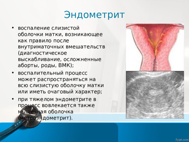 Эндометрит воспаление слизистой оболочки матки, возникающее как правило после внутриматочных вмешательств (диагностическое выскабливание, осложненные аборты, роды, ВМК); воспалительный процесс может распространяться на всю слизистую оболочку матки или иметь очаговый характер; при тяжелом эндометрите в процесс вовлекается также мышечная оболочка (метроэндометрит). 