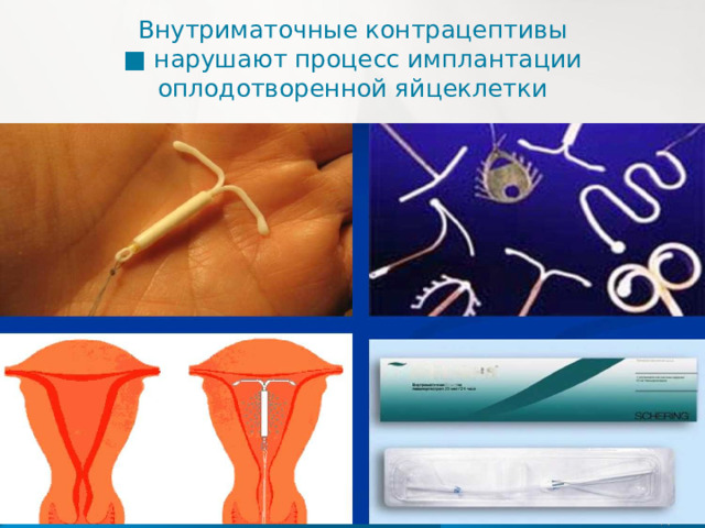 Внутриматочные контрацептивы  ■ нарушают процесс имплантации оплодотворенной яйцеклетки   