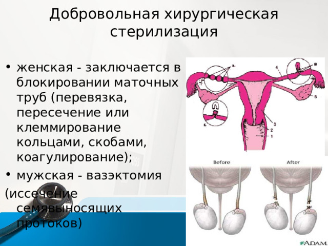 Добровольная хирургическая  стерилизация   женская - заключается в блокировании маточных труб (перевязка, пересечение или клеммирование кольцами, скобами, коагулирование); мужская - вазэктомия (иссечение семявыносящих протоков) 