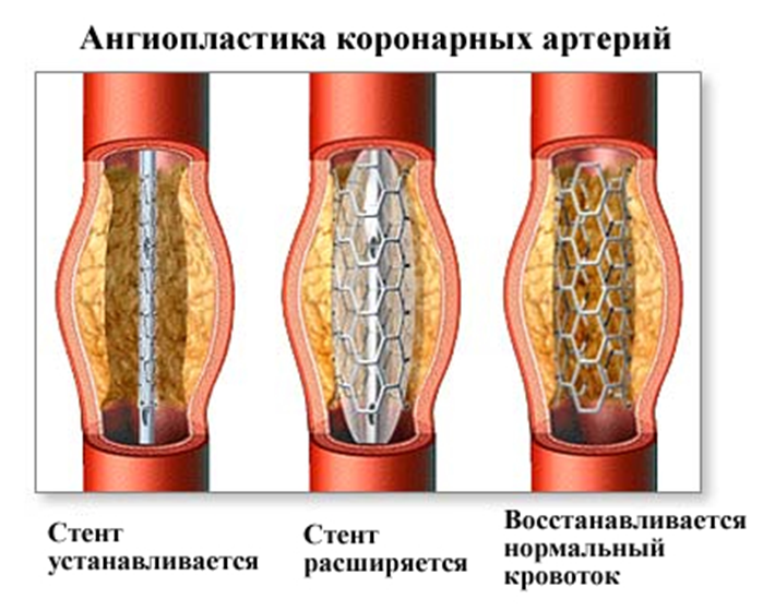 Стенд коронарных сосудов. ТРАНСЛЮМИНАЛЬНАЯ коронарная ангиопластика. Баллонная ангиопластика и стентирование. Стентирование сосудов сердца. Коронарное стентирование сосудов сердца.