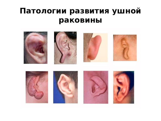 Патологии развития ушной раковины 