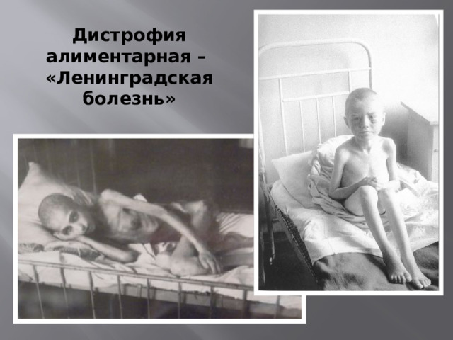 Дистрофия алиментарная – «Ленинградская болезнь» 