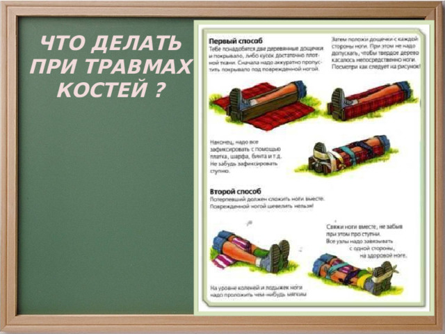 ЧТО ДЕЛАТЬ ПРИ ТРАВМАХ КОСТЕЙ ? 