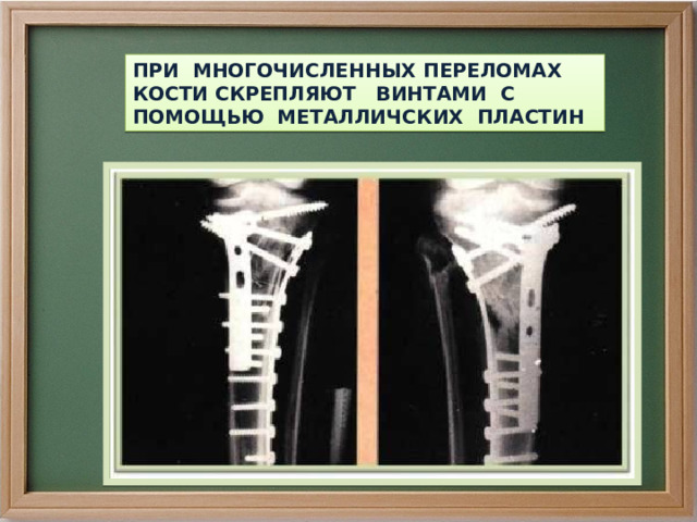 ПРИ МНОГОЧИСЛЕННЫХ ПЕРЕЛОМАХ КОСТИ СКРЕПЛЯЮТ ВИНТАМИ С ПОМОЩЬЮ МЕТАЛЛИЧСКИХ ПЛАСТИН 