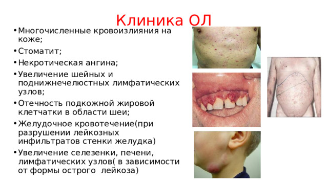 Клиника ОЛ Многочисленные кровоизлияния на коже; Стоматит; Некротическая ангина; Увеличение шейных и поднижнечелюстных лимфатических узлов; Отечность подкожной жировой клетчатки в области шеи; Желудочное кровотечение(при разрушении лейкозных инфильтратов стенки желудка) Увеличение селезенки, печени, лимфатических узлов( в зависимости от формы острого лейкоза) 
