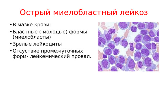 Острый миелобластный лейкоз В мазке крови: Бластные ( молодые) формы (миелобласты) Зрелые лейкоциты Отсуствие промежуточных форм- лейкемический провал. 