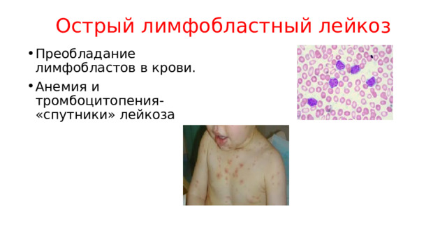 Острый лимфобластный лейкоз Преобладание лимфобластов в крови. Анемия и тромбоцитопения- «спутники» лейкоза 