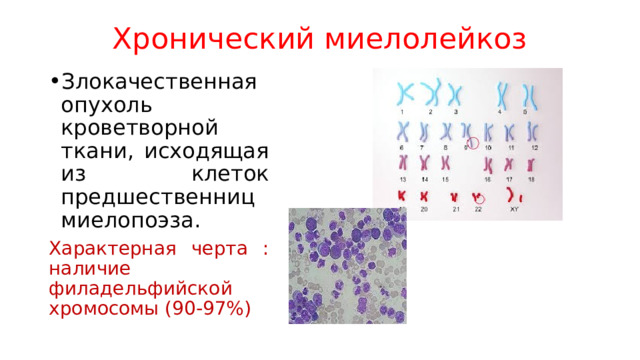 Хронический миелолейкоз Злокачественная опухоль кроветворной ткани, исходящая из клеток предшественниц миелопоэза. Характерная черта : наличие филадельфийской хромосомы (90-97%) 