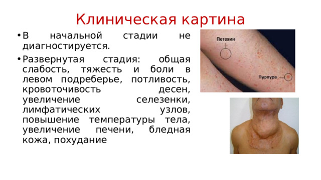 Клиническая картина В начальной стадии не диагностируется. Развернутая стадия: общая слабость, тяжесть и боли в левом подреберье, потливость, кровоточивость десен, увеличение селезенки, лимфатических узлов, повышение температуры тела, увеличение печени, бледная кожа, похудание 